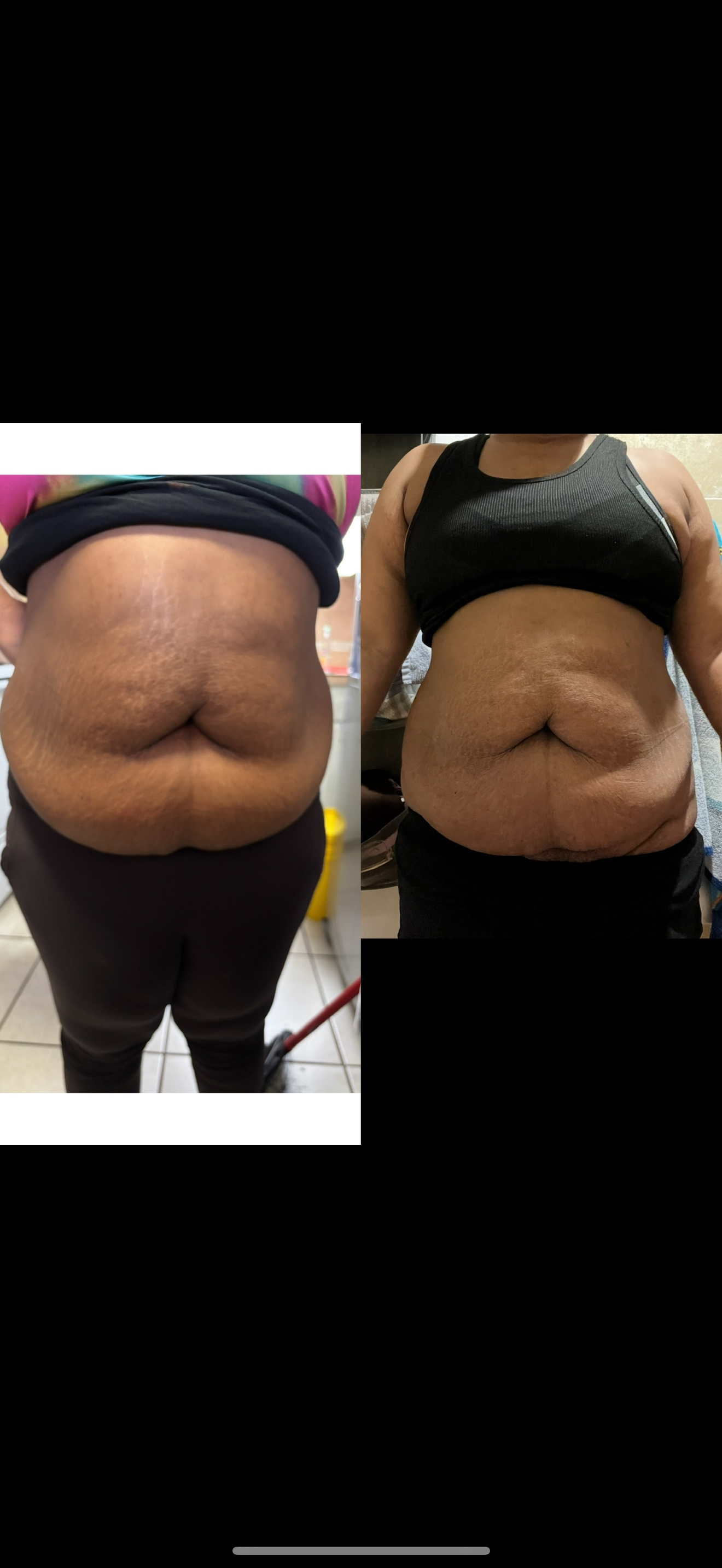 Liquid Lipo