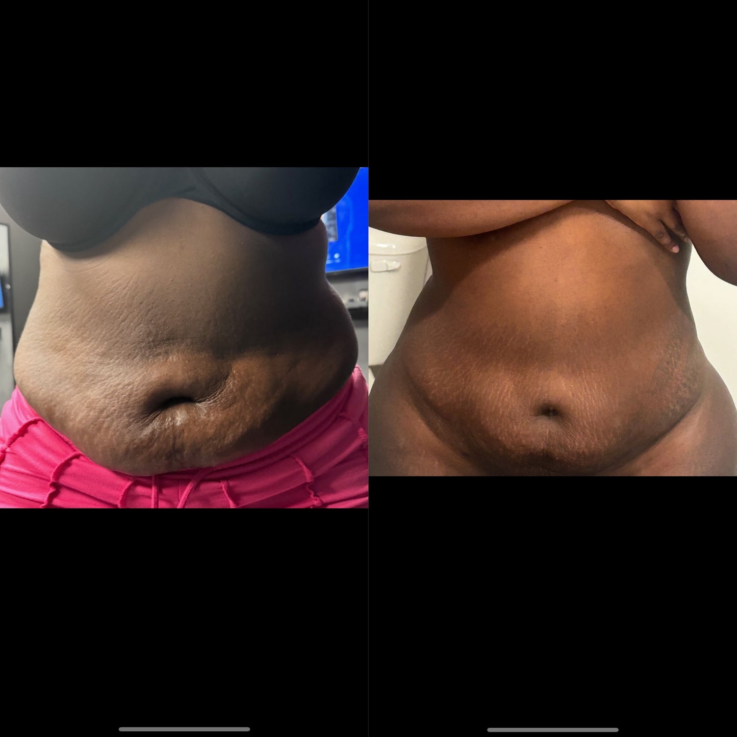 Liquid Lipo